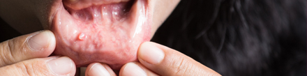 Cáncer Oral