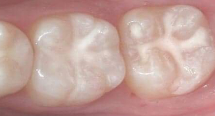 Selladores de fosas y fisuras