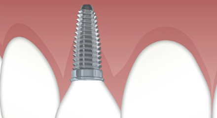 Implantes Dentales