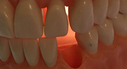 Importancia de Remplazar un Diente Perdido