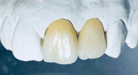 Prótesis Parcial Fija