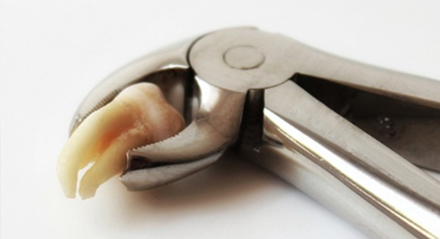 El alvéolo seco una complicación después de una extracción dental