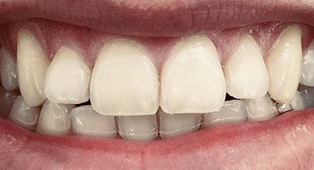 ¿Por qué los dientes cambian de color?